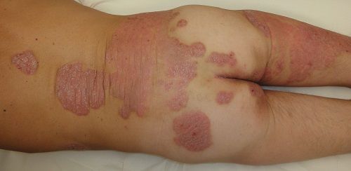 Psoriasisbehandlung