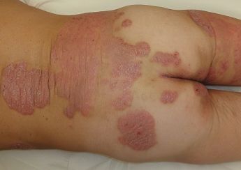 Psoriasisbehandlung