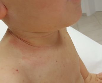 Hautausschlag bei Kind