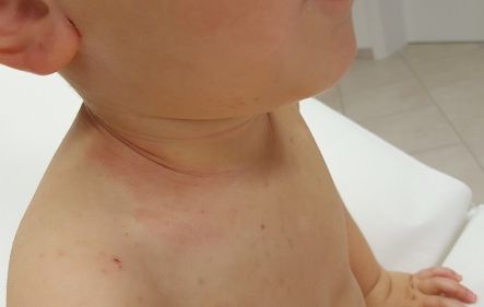 Hautausschlag bei Kind