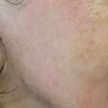 1 Woche nach Peeling