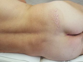 Psoriasisbehandlung